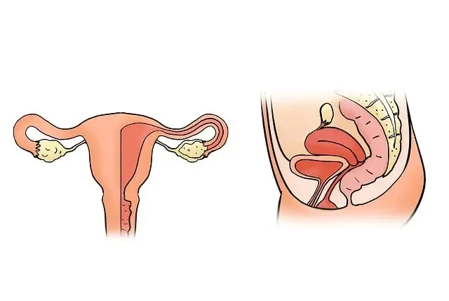 자궁경부암 초기증상